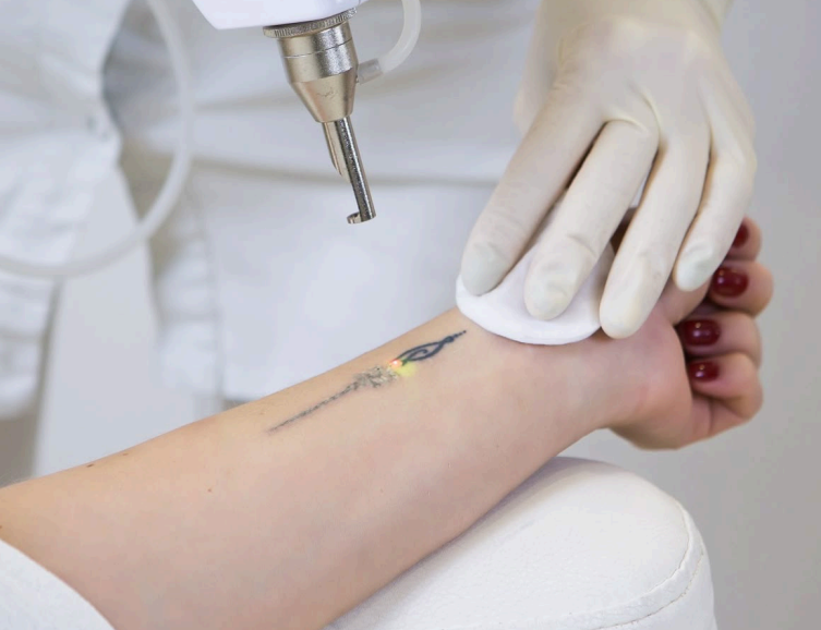 Eliminación de tatuajes