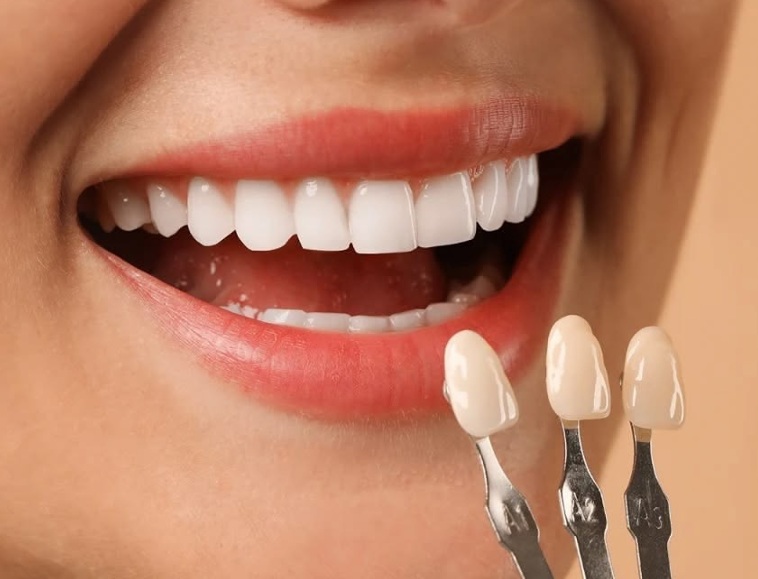 Carillas dentales con sistema cerec