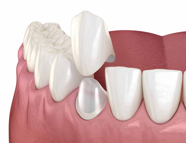 Coronas dentales con sistema cerec
