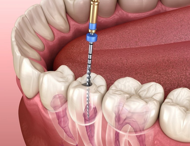 Endodoncia