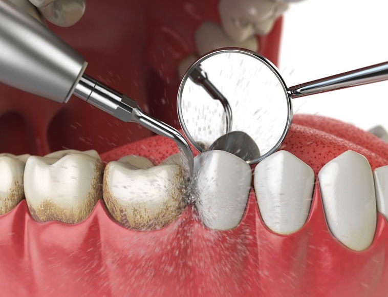 Periodoncia